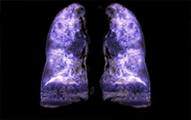 Greffe du poumon : prédire les dysfonctionnements